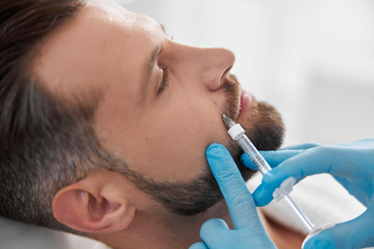 Nasolabialfalte unterspritzen mit Hyaluronsäure